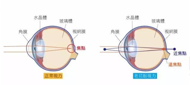 白內(nèi)障和老花眼區(qū)別，老花眼發(fā)病率正呈現(xiàn)年輕化趨勢(shì)