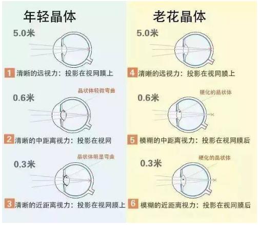 近視就不會老花了嗎？